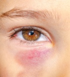 מיעוט טסיות בילדים: כל מה שהורים צריכים לדעת על ITP-תמונה